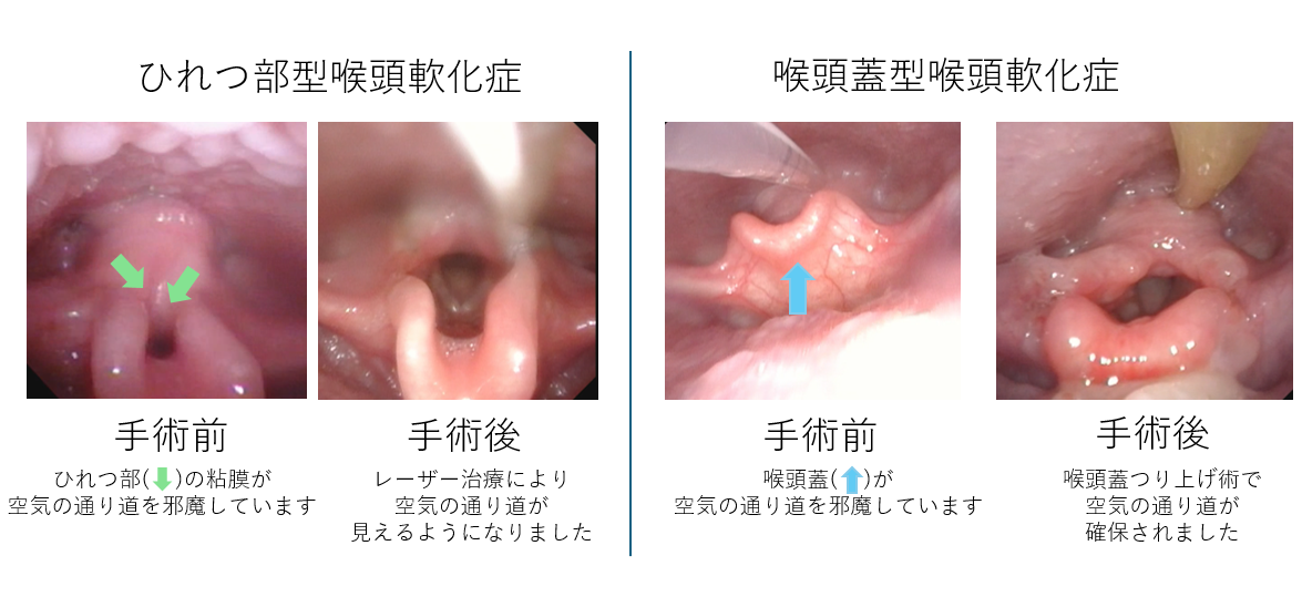 小児耳鼻咽喉科ページ（案） | 北海道立子ども総合医療・療育